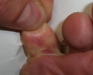 Athlete's foot